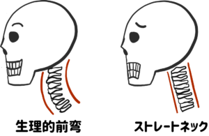 生理的前弯とストレートネック